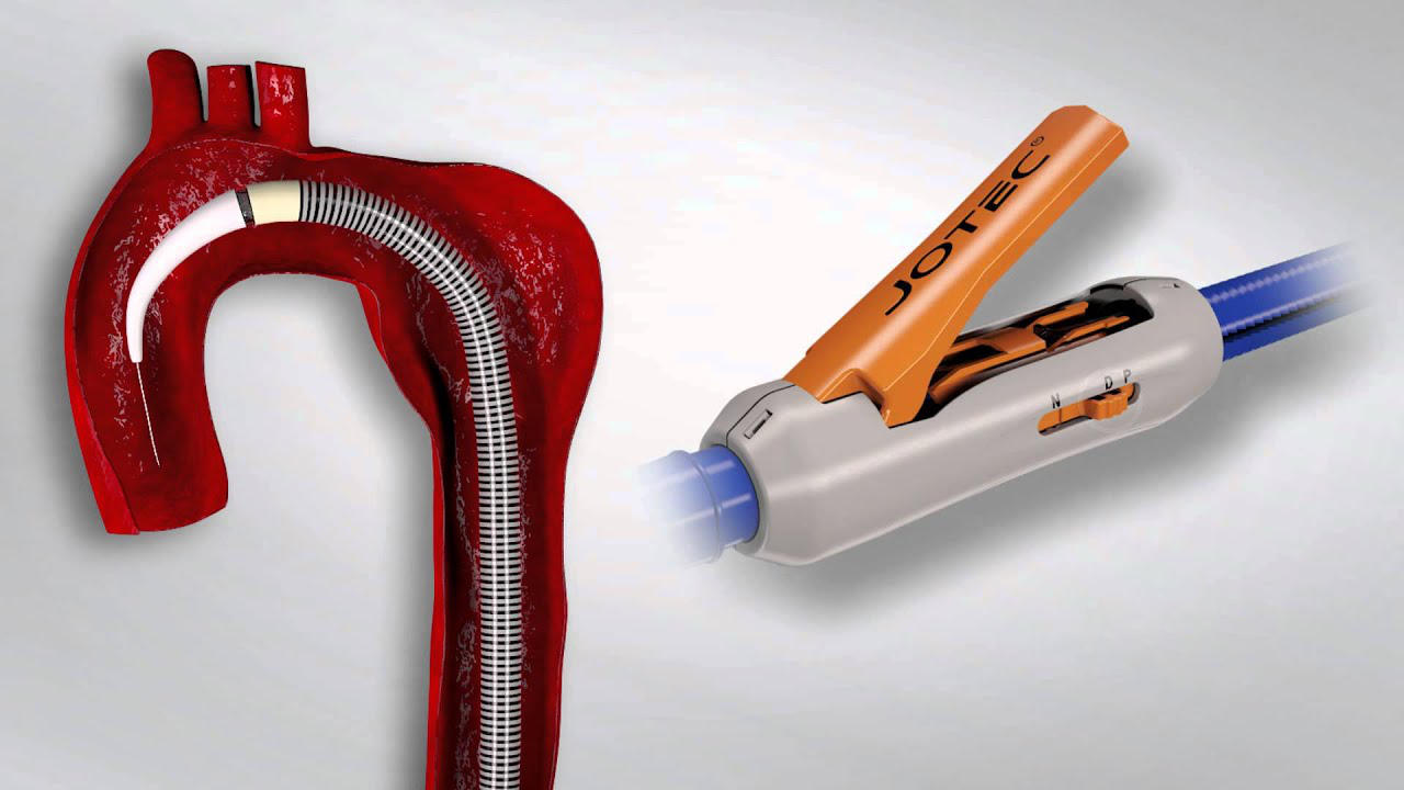 Aortic aneurysm intervention